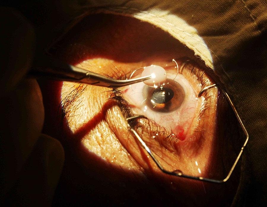 Cataract Screening & Surgery